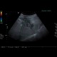 Liver metastasis of adenocarcinoma of colon, colorectal carcinoma, biopsy: US - Ultrasound